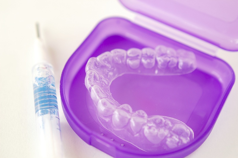 歯列矯正しながらホワイトニングする一石二鳥な方法教えます