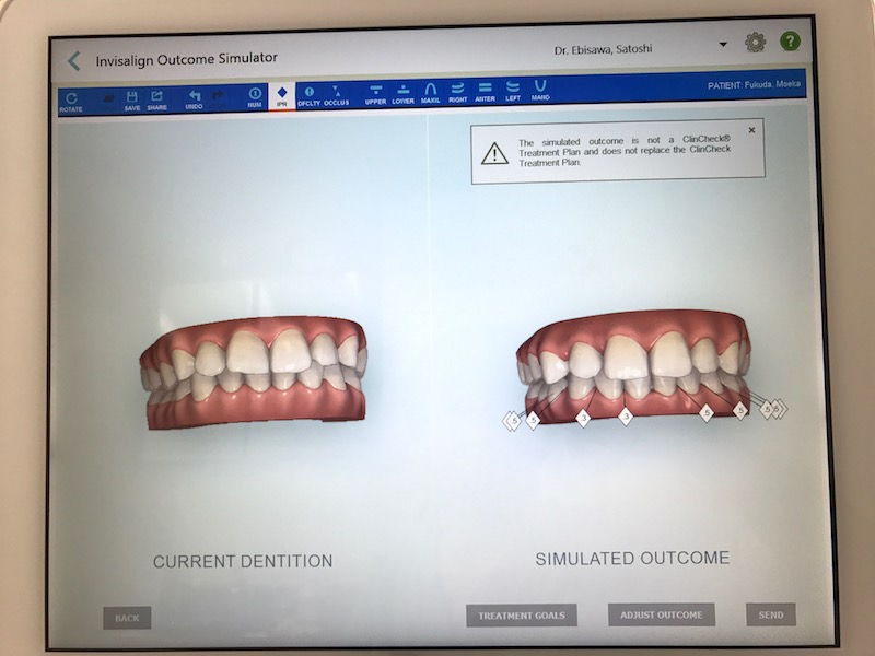 インビザライン無料相談の流れ