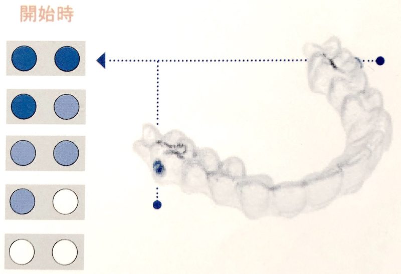 10代向けのインビザライン・ティーンと大人用のインビザラインとの違いを解説する