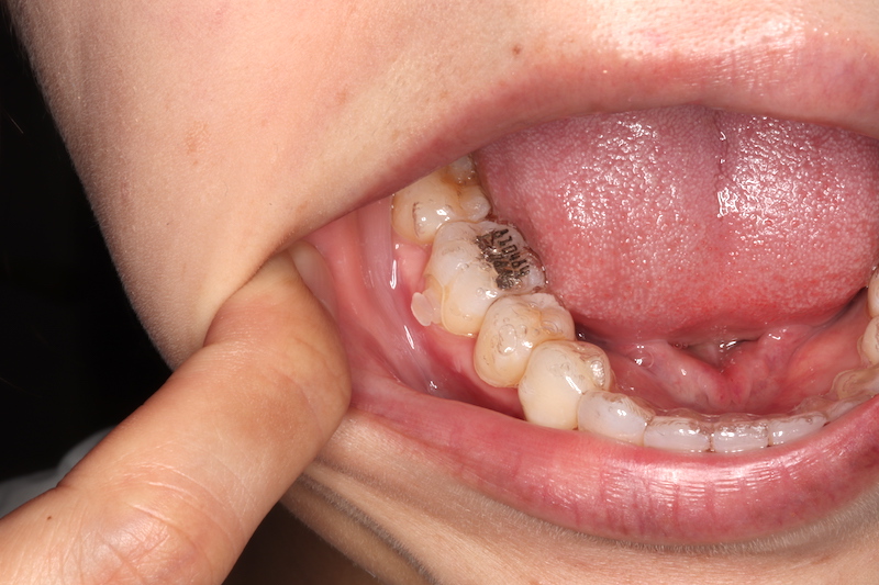 インビザライン治療中に虫歯になったら？虫歯があったら始められない？