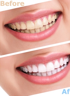 歯の色が気になる