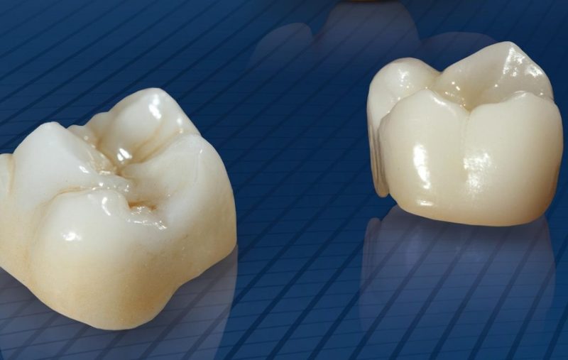 保険適用の白い歯（CAD/CAM キャドカム）